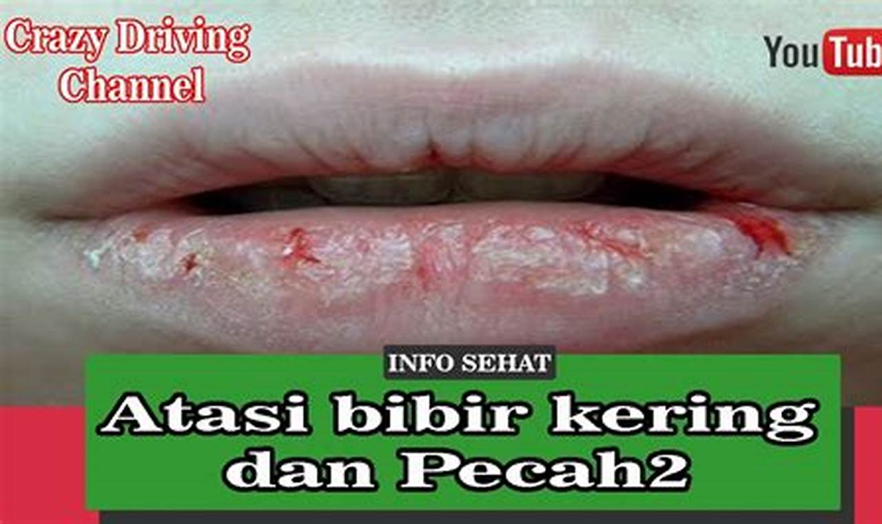 cara mengatasi bibir pecah pecah